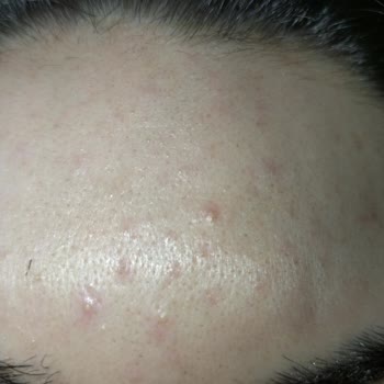 Bioderma Atoderm Créme Ultra Sivilce Yaptı.