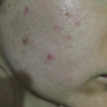 Bioderma Atoderm Créme Ultra Sivilce Yaptı.