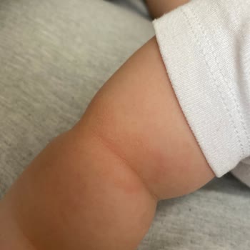 Mustela Ve Egzama Sorunu