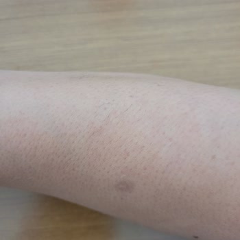 Glam Life Güzellik & Cilt Bakım Merkezi Kolumu Yaktı İz Kaldı