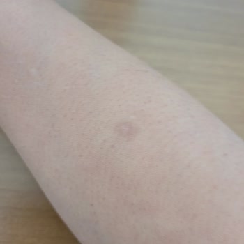 Glam Life Güzellik & Cilt Bakım Merkezi Kolumu Yaktı İz Kaldı