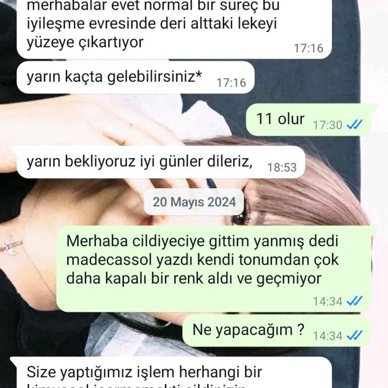 Şirinevler Zs Beauty Center Yosun Peeling Faciası