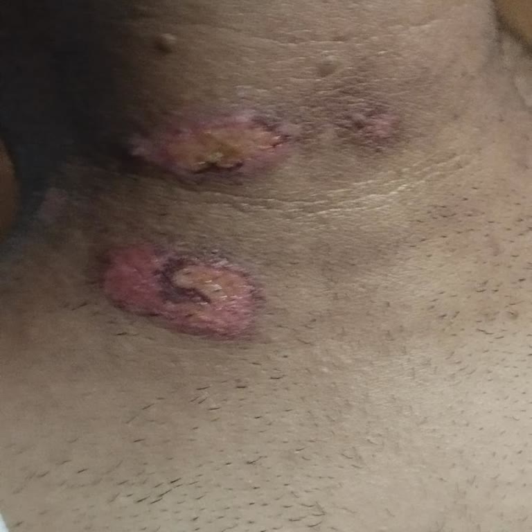 Karabük Sarat Beauty Başarısız Lazer Epilasyon