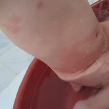 Prima Bebek Bezi Alerji Cildimi Mahvetti