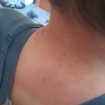 Prima Bebek Bezi Alerji Cildimi Mahvetti