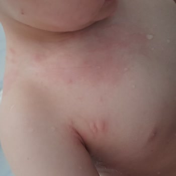 Prima Bebek Bezi Alerji Cildimi Mahvetti