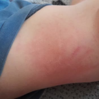 Prima Bebek Bezi Alerji Cildimi Mahvetti