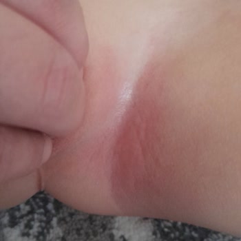 Prima Bebek Bezi Alerji Cildimi Mahvetti