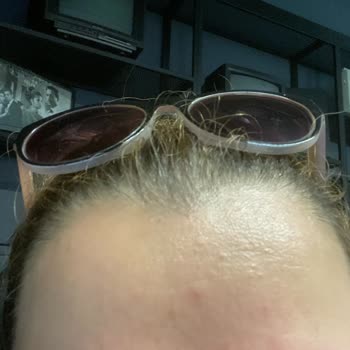 Sinoz 24K Gold Beauty Serum Ürünü Yüzde Sivilce Yaptı