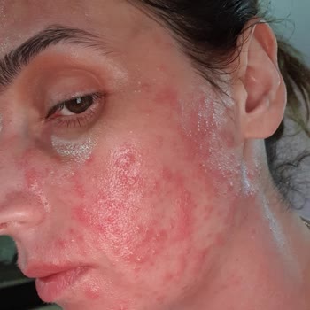 Palette Saç Boyası Alerji Yaptı