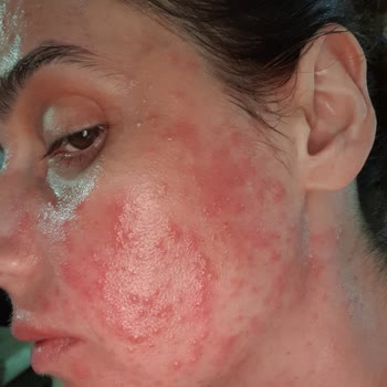 Palette Saç Boyası Alerji Yaptı