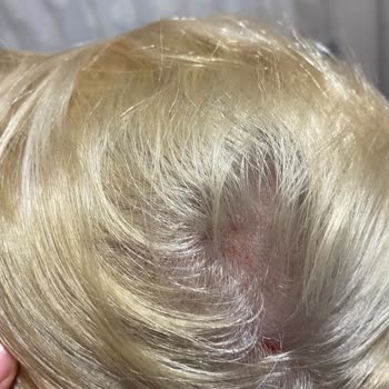 Saç Derim Yandı Palette