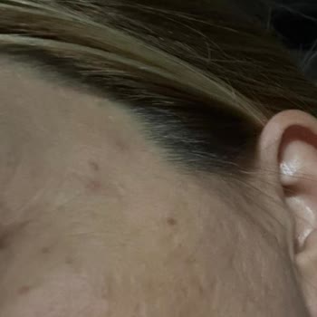 Yves Rocher Ürünleri Alerjik Reaksiyon Yaptı