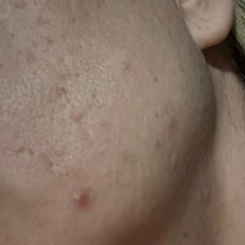 Yves Rocher Ürünleri Alerjik Reaksiyon Yaptı