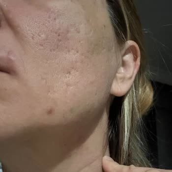 Yves Rocher Ürünleri Alerjik Reaksiyon Yaptı