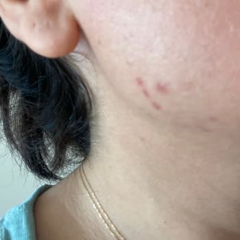 Bioderma Güneş Kremi Sivilce Ve Leke Oluşumu