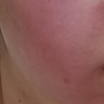 Garnier Yüzümde Alerjiye Sebebiyet Verdi!