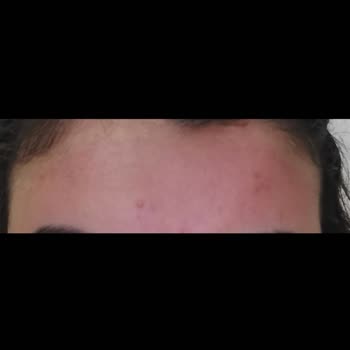 Garnier Yüzümde Alerjiye Sebebiyet Verdi!