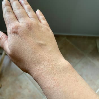 Bepanthen Derma Causes Blister and Burning Sensation