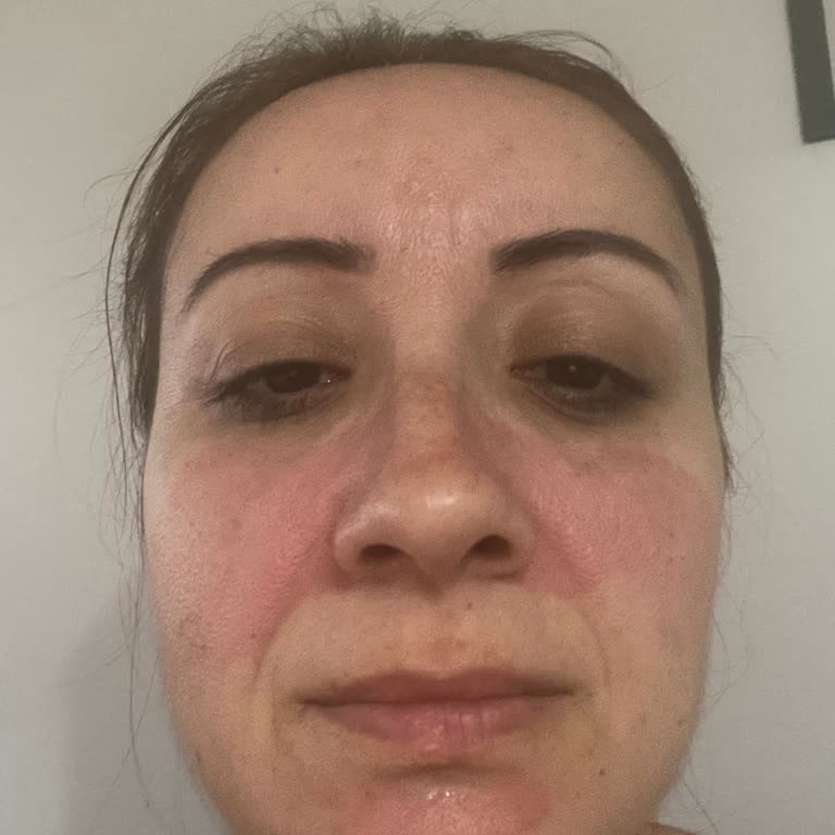 Yves Rocher Yüzümü Yakan Ürün