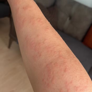 Vista Beauty & Aesthetic Vücutta Lazer Yanığı