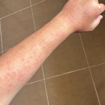 Vista Beauty & Aesthetic Vücutta Lazer Yanığı