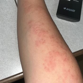 Vista Beauty & Aesthetic Vücutta Lazer Yanığı