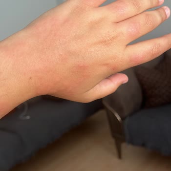 Vista Beauty & Aesthetic Vücutta Lazer Yanığı