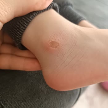 LCW Ciddi Yaralar Yapan Sandalet