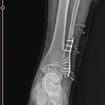 SGK Ayağım Burkulma Sonucu Kırıldı