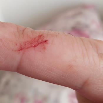 Assu Kapakta Çapak Olması