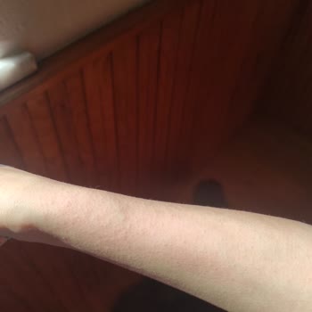 Nivea Güneş Kremi Alerji