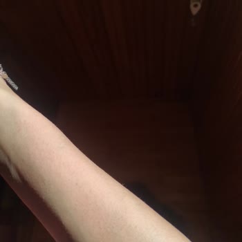 Nivea Güneş Kremi Alerji