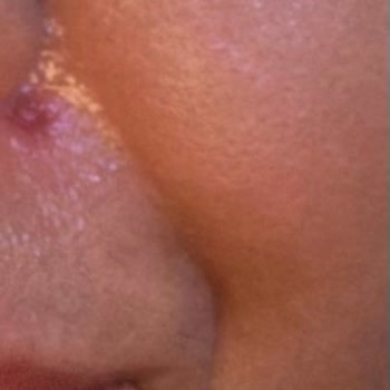 Florence Nightingale Hastaneleri Dermatoloji İşlemi Sonucu Yüzümde Yanıklar Oluştu