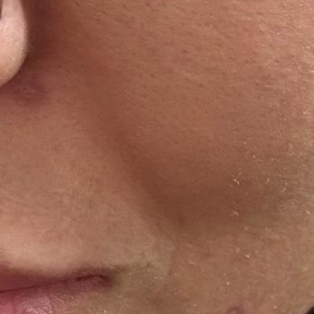 Florence Nightingale Hastaneleri Dermatoloji İşlemi Sonucu Yüzümde Yanıklar Oluştu