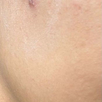 Florence Nightingale Hastaneleri Dermatoloji İşlemi Sonucu Yüzümde Yanıklar Oluştu