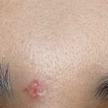 Florence Nightingale Hastaneleri Dermatoloji İşlemi Sonucu Yüzümde Yanıklar Oluştu