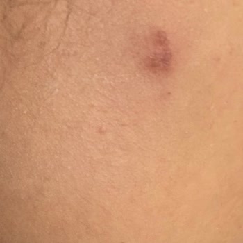 Florence Nightingale Hastaneleri Dermatoloji İşlemi Sonucu Yüzümde Yanıklar Oluştu