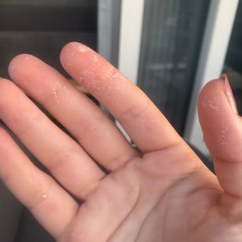 Vanish Kosla Elimde Lekelenmelere Sebep Oldu