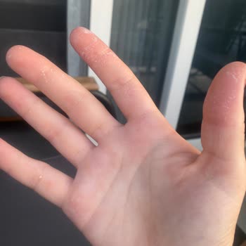 Vanish Kosla Elimde Lekelenmelere Sebep Oldu