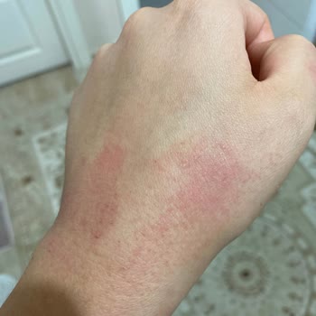 Sebamed Kızarıklık Yanma Alerji