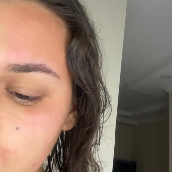 Sebamed Kızarıklık Yanma Alerji