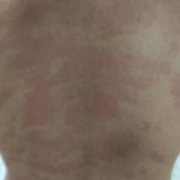 Anatolium Estetik Güzellik Merkezi Steril Olmayan Aletler Ve Sertifikasız Elemanlar Nedeniyle Enfeksiyon Riski