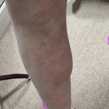 Anatolium Estetik Güzellik Merkezi Steril Olmayan Aletler Ve Sertifikasız Elemanlar Nedeniyle Enfeksiyon Riski