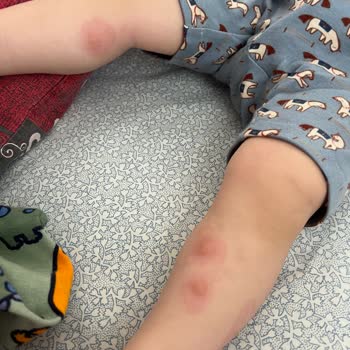 Nurse Harvey’s Buzzyderm Kremi Bebek Cildinde Beklenmedik Reaksiyon Yarattı!