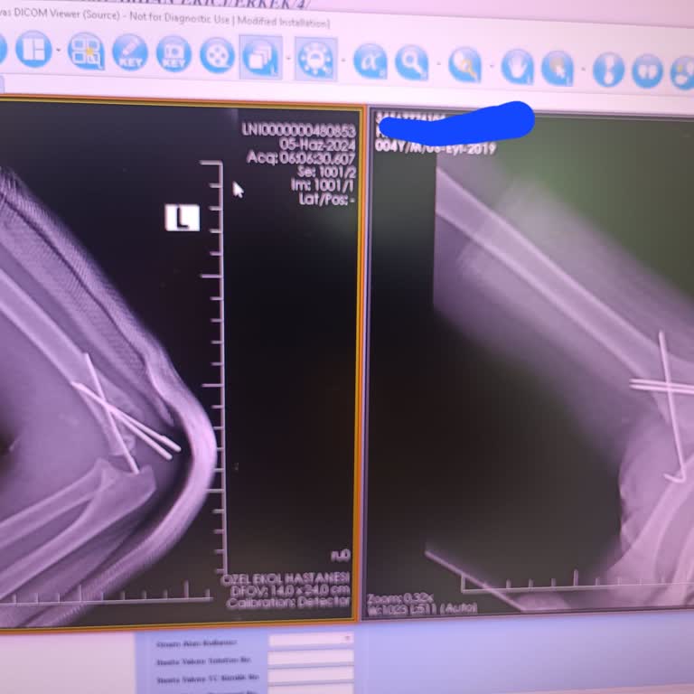 Hilltown Gagapagos Çocuk Sakatlanması