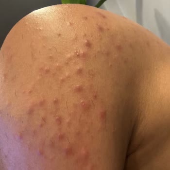 Veet Men Tüy Dökücü Krem Kullanımı Sonrası Cilt Sorunları