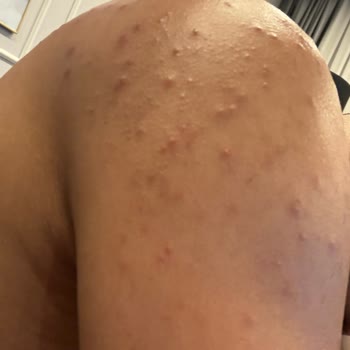 Veet Men Tüy Dökücü Krem Kullanımı Sonrası Cilt Sorunları