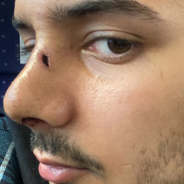 Özel Tanfer Hastanesi Ameliyat Esnasında Burun Deldi