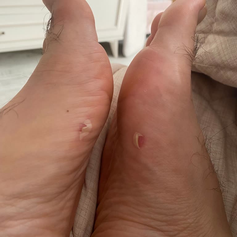 Lescon Ayağımda Sorun Buldu Ayakkabı Da Sorun Yokmuş